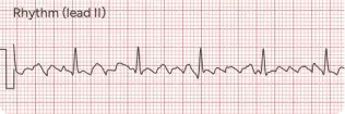Atrial Flutter